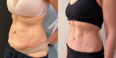 Tummy Tuck case #6356