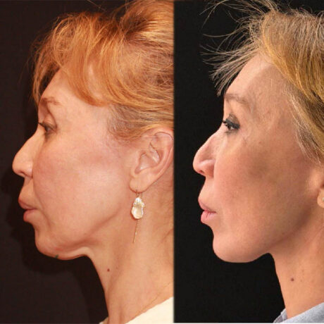 Deep Plane Facelift case #6276