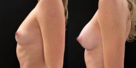 Breast Augmentation case #6298