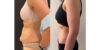 Tummy Tuck case #6356 slider thumbnail