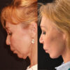 Deep Plane Facelift case #6276 slider thumbnail