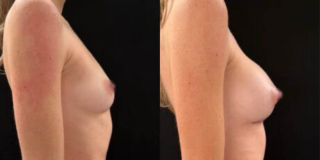 Breast Augmentation case #6298