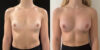 Breast Augmentation case #6313