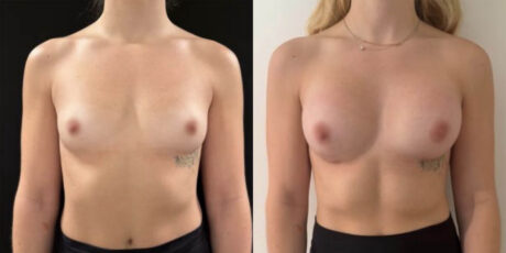 Breast Augmentation case #6313