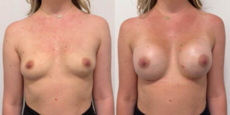 Breast Augmentation case #6315