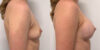 Breast Augmentation case #6315 slider thumbnail