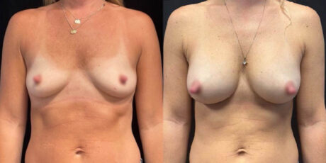 Breast Augmentation case #6318