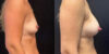 Breast Augmentation case #6318 slider thumbnail