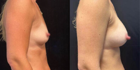 Breast Augmentation case #6318