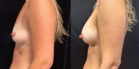 Breast Augmentation case #6318