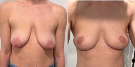 Breast Lift case #6322