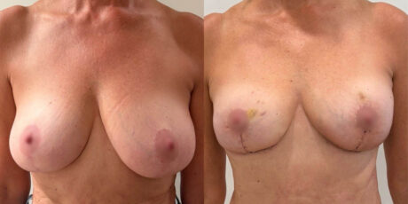 Breast Lift case #6324