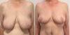 Breast Lift case #6326 slider thumbnail