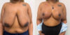 Breast Reduction case #6328 slider thumbnail