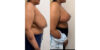 Breast Reduction case #6328 slider thumbnail