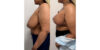 Breast Reduction case #6328 slider thumbnail