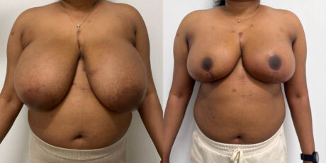 Breast Reduction case #6332