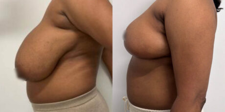 Breast Reduction case #6332