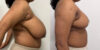 Breast Reduction case #6332 slider thumbnail