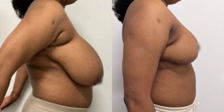 Breast Reduction case #6332