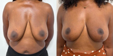 Breast Cancer Reconstruction case #6337