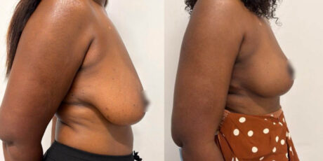 Breast Cancer Reconstruction case #6337