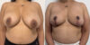 Breast Cancer Reconstruction case #6341 slider thumbnail