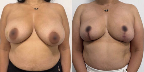 Breast Cancer Reconstruction case #6341