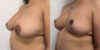 Breast Cancer Reconstruction case #6341 slider thumbnail