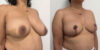 Breast Cancer Reconstruction case #6341 slider thumbnail