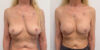 Breast Cancer Reconstruction case #6349 slider thumbnail