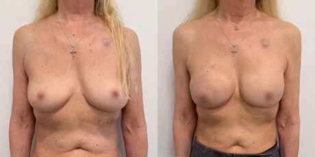 Breast Cancer Reconstruction case #6349