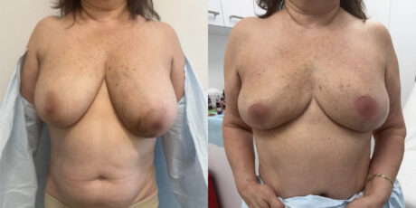 Breast Cancer Reconstruction case #6351